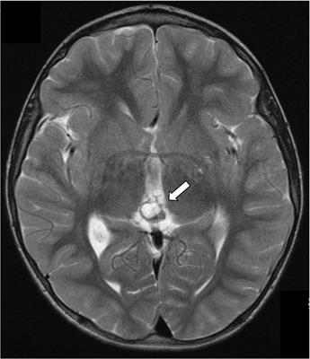 Case report: Fluctuating tumor markers in a boy with gonadotropin-releasing hormone-independent precocious puberty induced by a pineal germ cell tumor